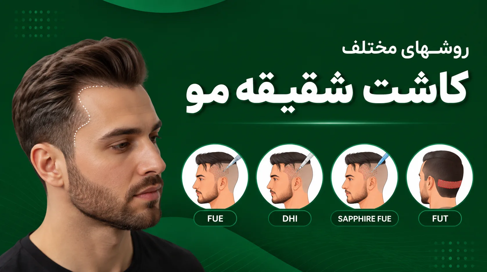 روشهای مختلف کاشت شقیقه مو